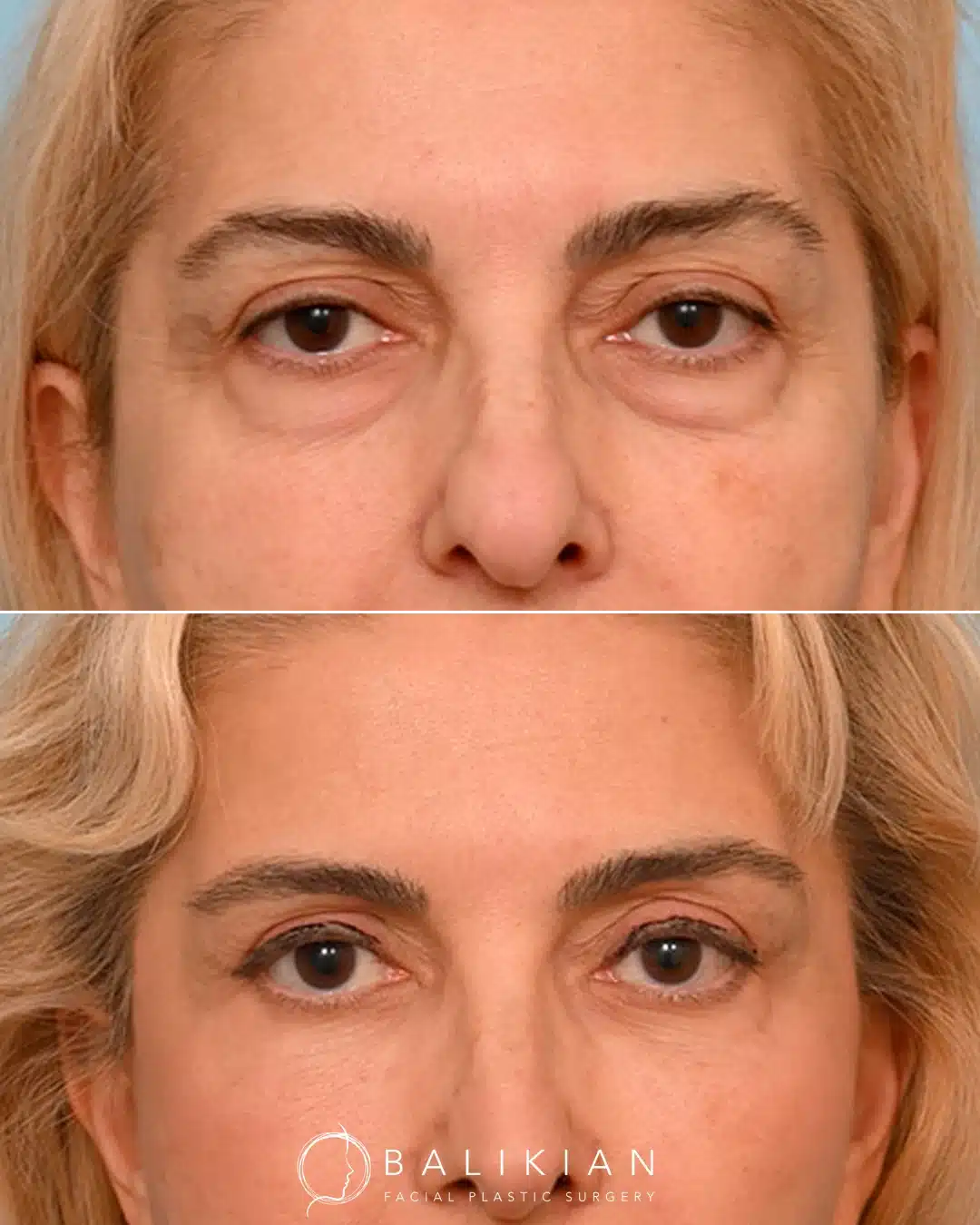 Female patient before and after eyelid surgery.