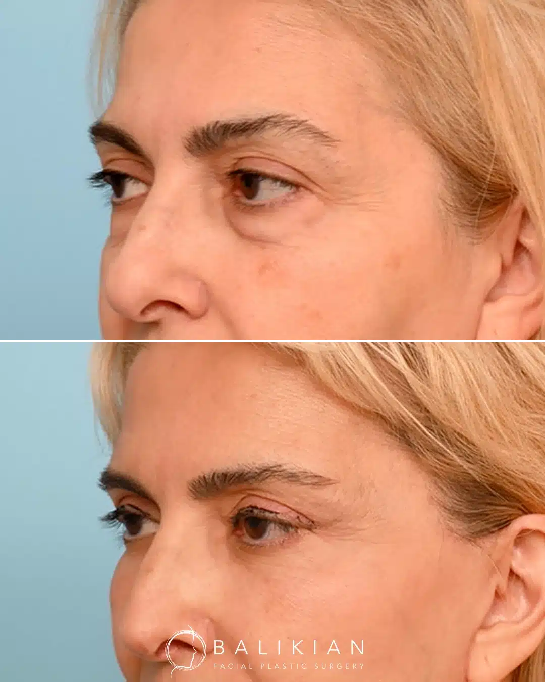 Left oblique view of a woman before and after blepharoplasty.