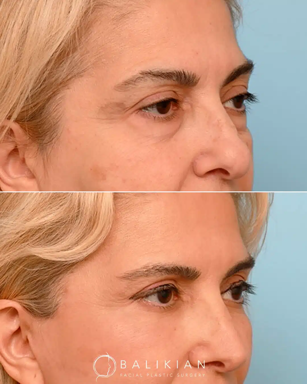 Right oblique view of a female patient’s blepharoplasty transformation.