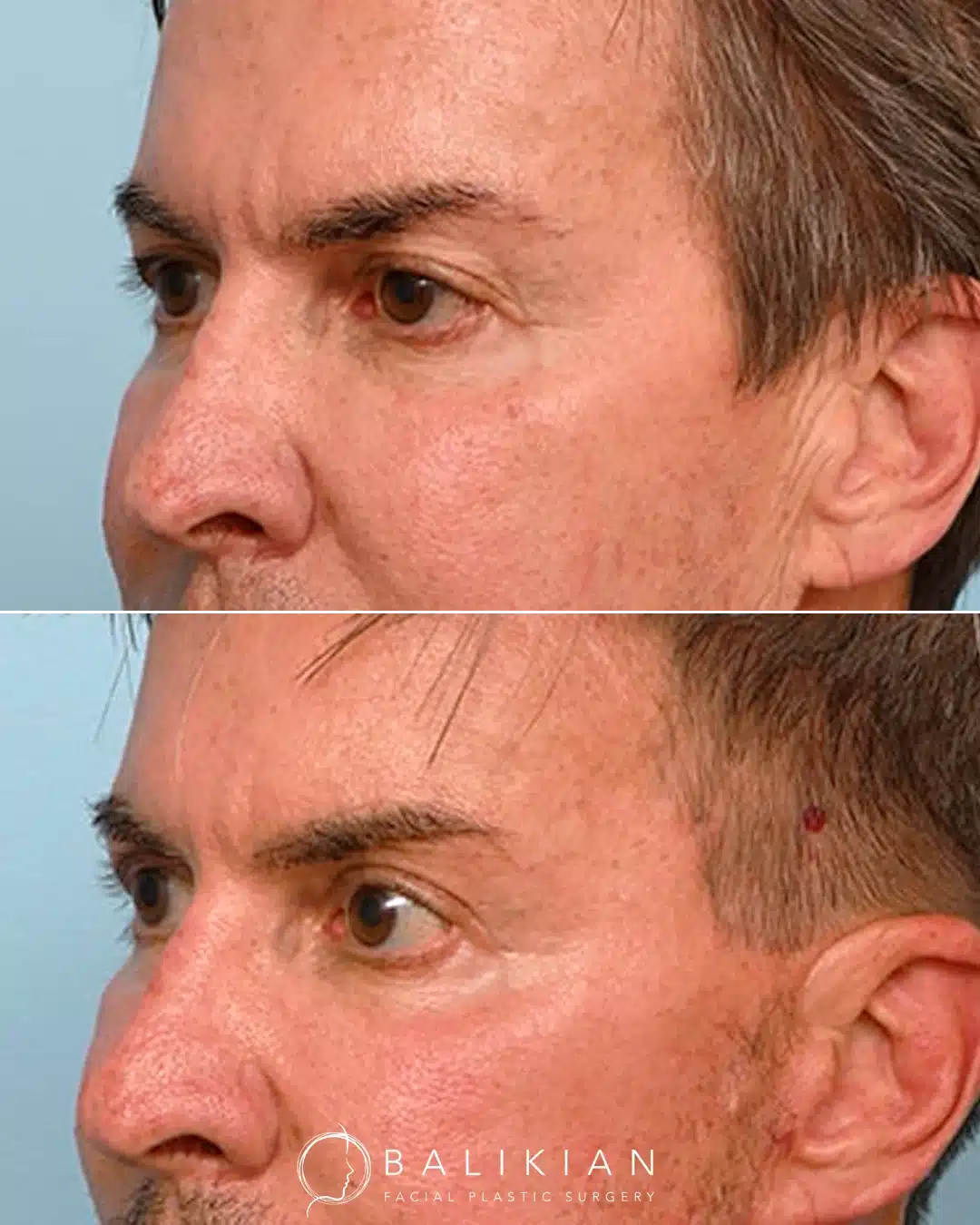 Left oblique view of a man before and after eyelid surgery.