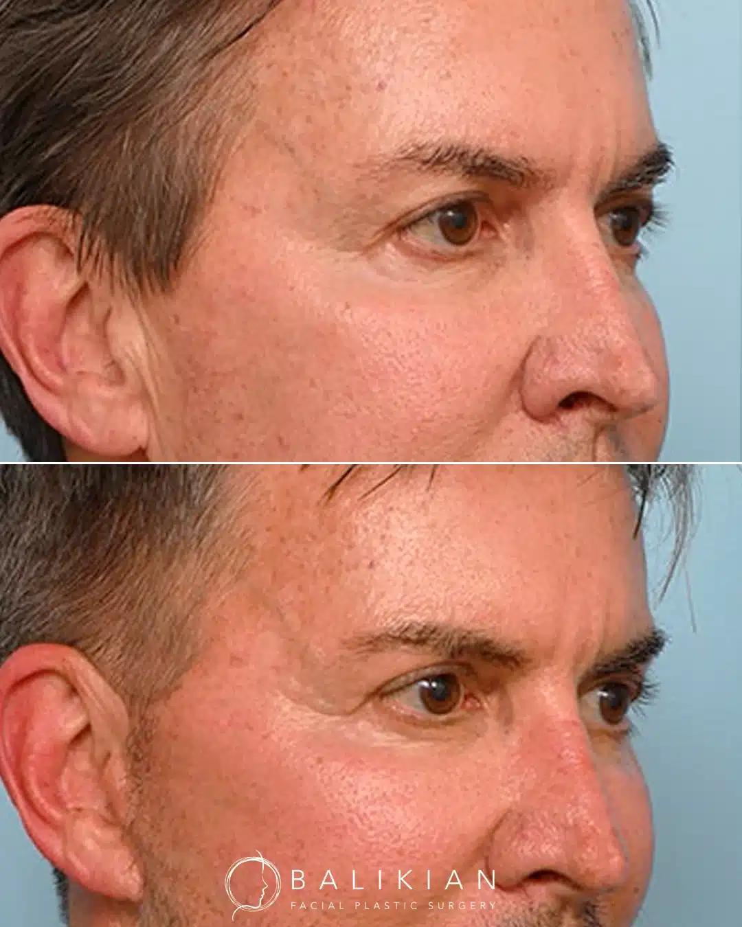 Right oblique view of a male blepharoplasty result.