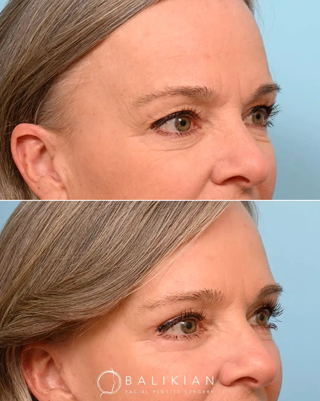 This patient in her 50s wanted a younger, smoother eye area while addressing overall facial aging. Dr. Balikian performed an upper and lower blepharoplasty to brighten and refresh her eyes as part of a full facial rejuvenation plan.