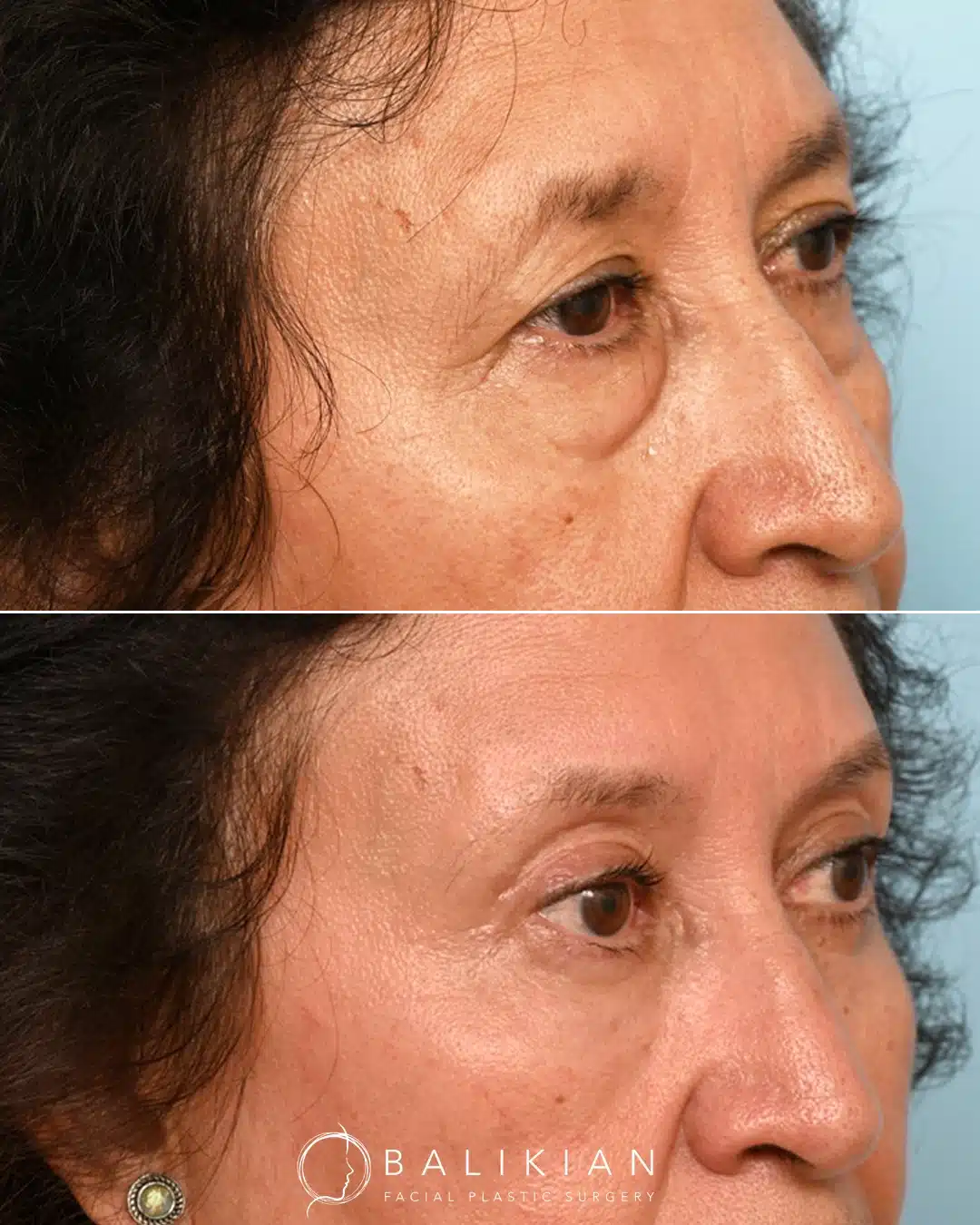 Oblique view before and after lower blepharoplasty demonstrating removal of under-eye bags and softening of hollows while maintaining a natural eye shape.