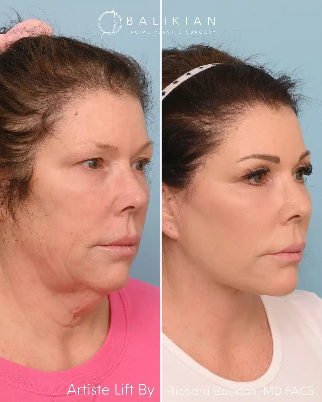 hree-quarter comparison of female patient before and after Artiste Lift™ deep plane facelift, highlighting youthful contours and improved skin tone.