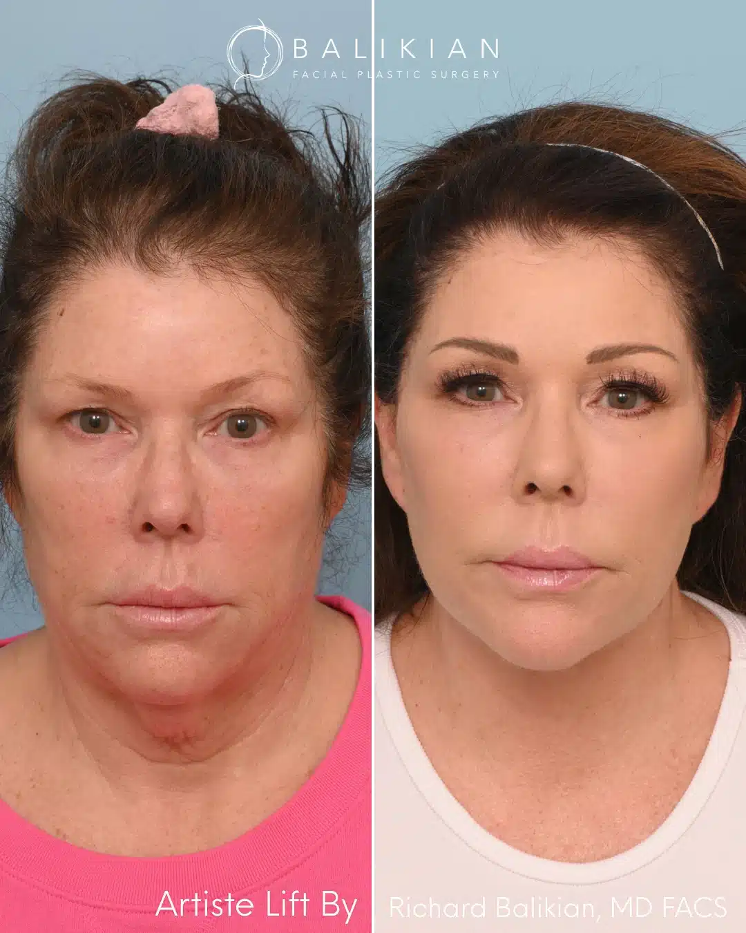 Front view of female patient before and after deep plane facelift, showing balanced facial proportions and smoother lower face.