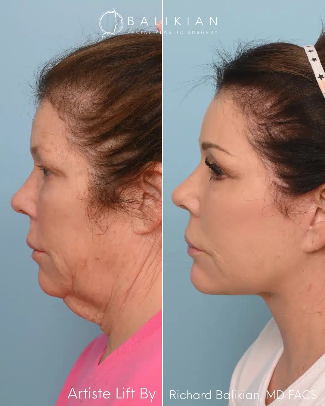 Side view comparison of female patient before and after facelift, showing natural results and improved skin texture.
