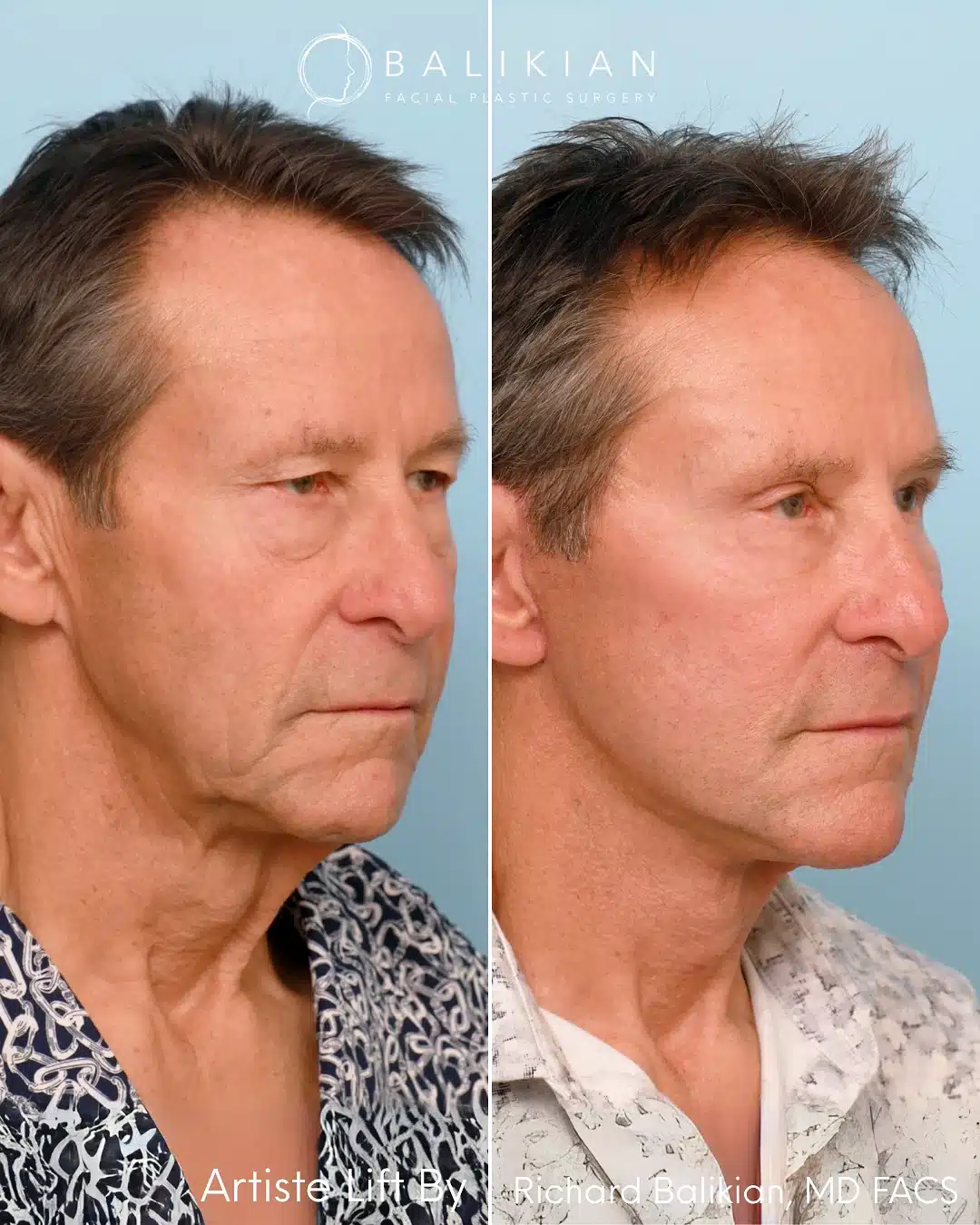 Male patient before and after Artiste Lift™ deep plane facelift, three-quarter angle showing a firmer neck and rejuvenated facial contours.