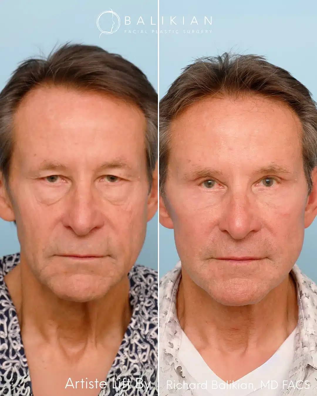 Front view of male patient before and after facelift, highlighting smoother neckline and natural, refreshed results