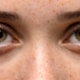 Close-up of a woman’s eyes showing natural eyelid contours and skin texture before blepharoplasty upper and lower eyelid surgery