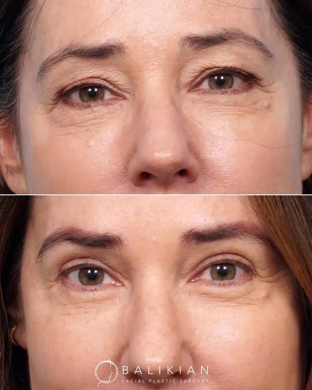 Before and after eyelid rejuvenation showing removal of excess skin and under-eye puffiness.