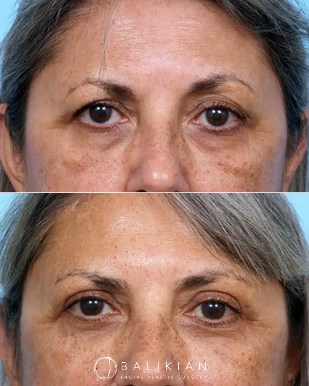 Lybarger: Bilateral Upper Blepharoplasty, Partial Face Fat Transfer, C02 Laser Green: Bilateral Upper Blepharoplasty and Extrernal Rhinoplasty Level II Capone: Bilateral Upper Blepharoplasty and Lower Transconjunctival with Skin Pinch, Partial Face Fat Transfer Segaar: Bilateral Lower Transconjunctival with Lower Eyelid Skin Pinch and Fat Transfer to Lower Eyes Skeoch: Bilateral Upper Blepharoplasty and Lower Transconjunctival Blepharoplasty with Fat Transfer Rubulcava: Bilateral Upper Blepharoplasty and Lower Transconjunctival Kriznak: Bilateral Upper Blepharoplasty and Lower Transconjunctival Blepharoplasty with Skin Pinch, C02 Laser to Lower Eyelids