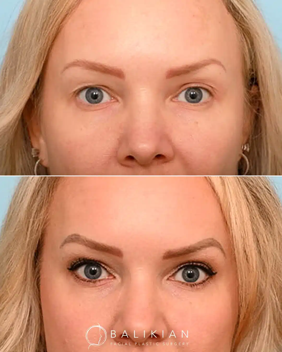 Before and after upper and lower eyelid surgery showing improved eyelid definition and a softer, more rested look.