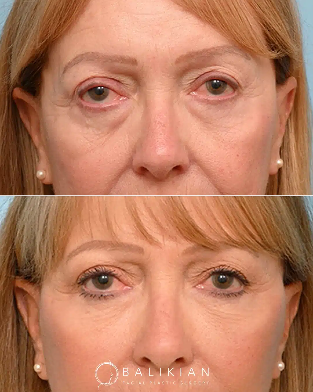 Before and after lower blepharoplasty for prominent under-eye bags.