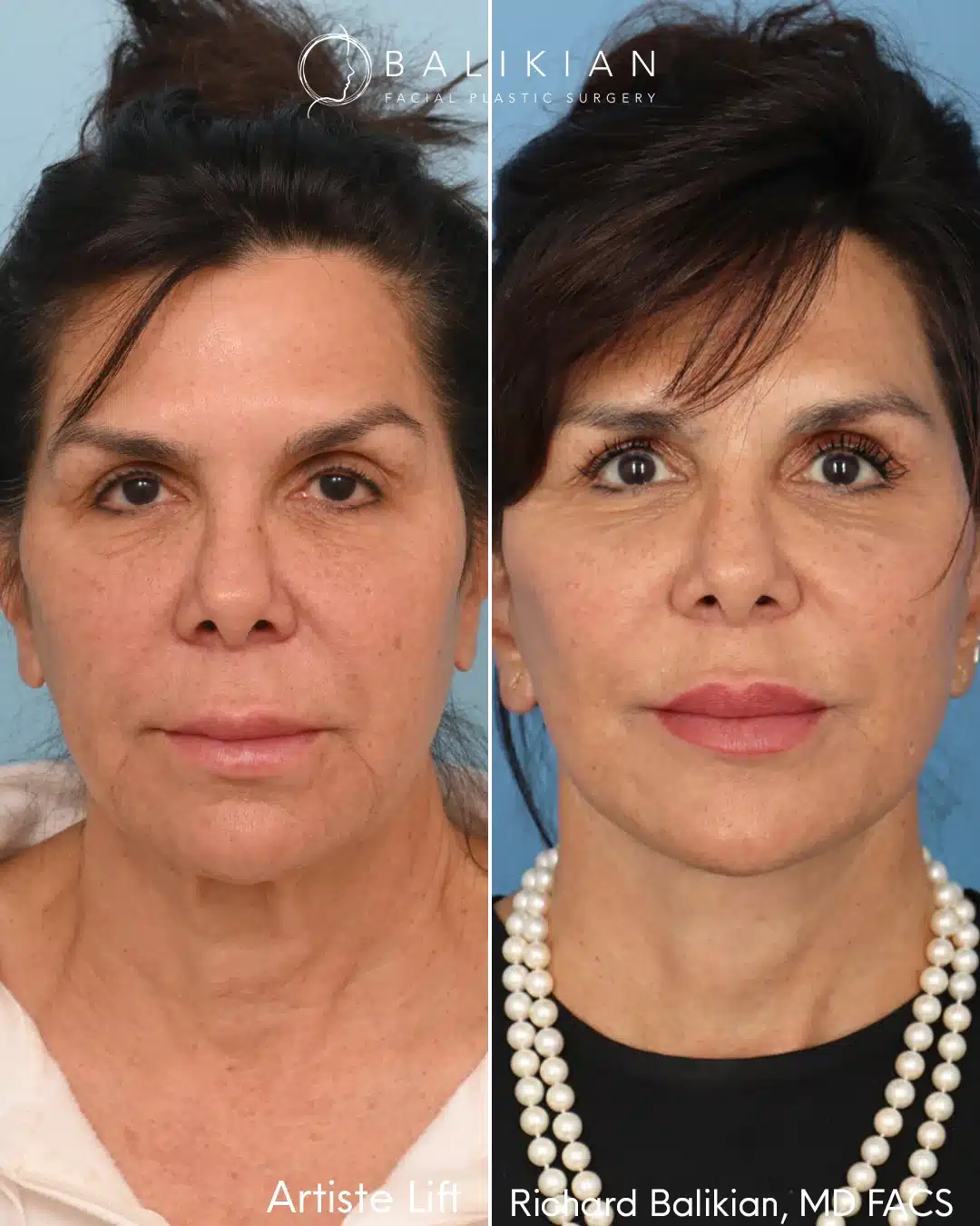 Front view before and after the Artiste Lift deep plane facelift by Dr. Richard Balikian, showing natural facial rejuvenation with improved midface volume, smoother skin tone, and a youthful neckline.