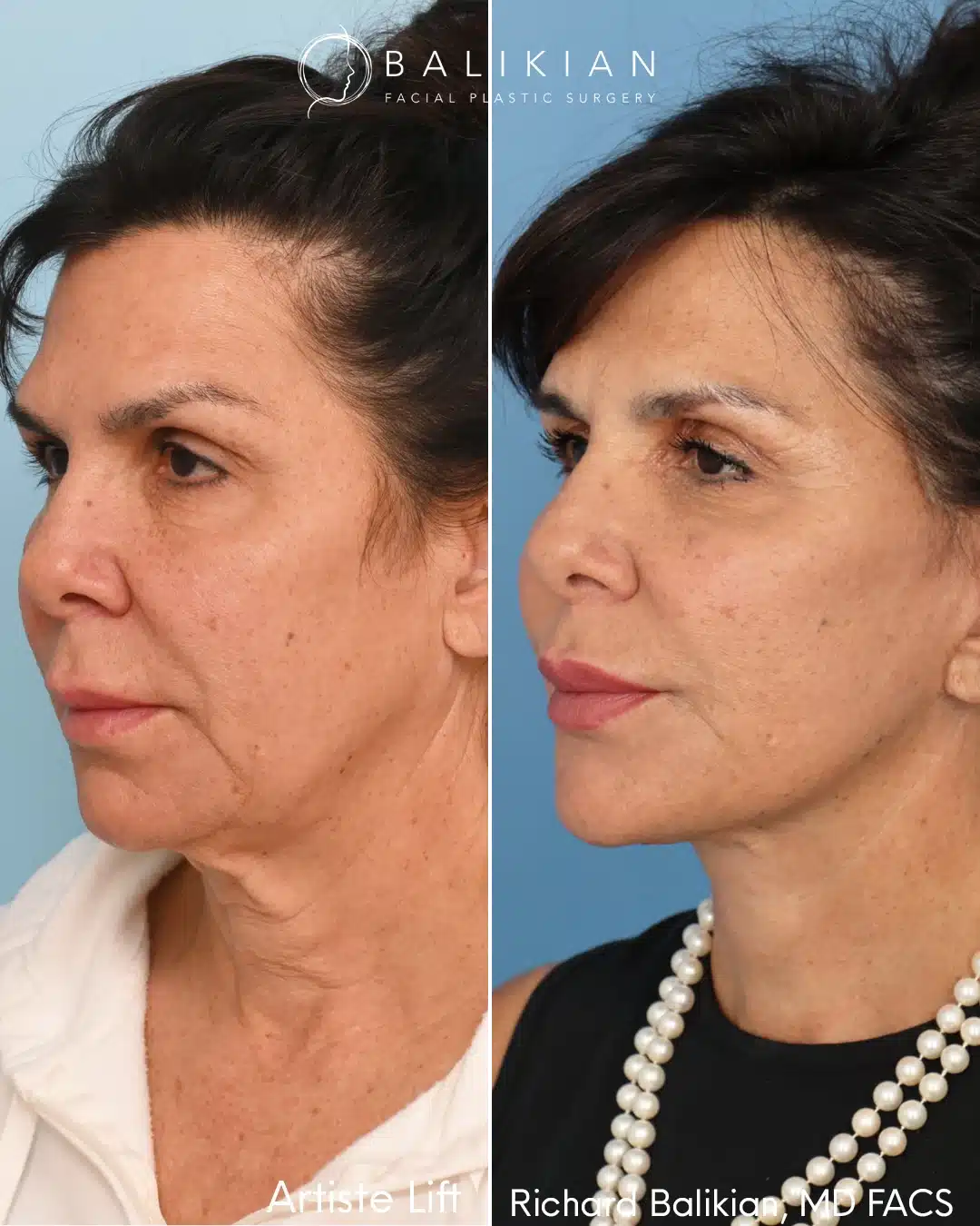 Before and after left oblique view following the Artiste Lift deep plane facelift by Dr. Richard Balikian.