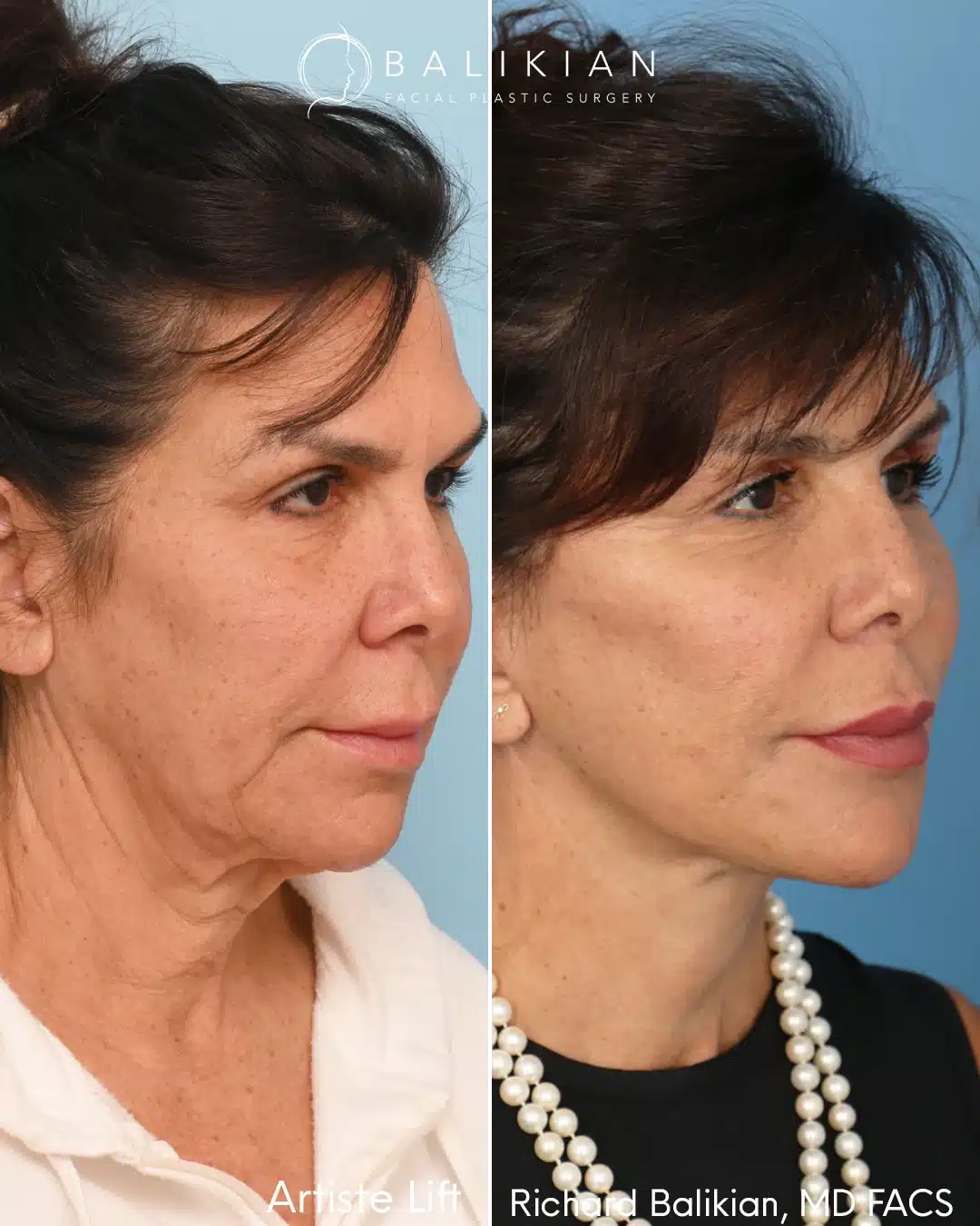 Before and after right oblique view of a patient who underwent the Artiste Lift deep plane facelift by Dr. Richard Balikian