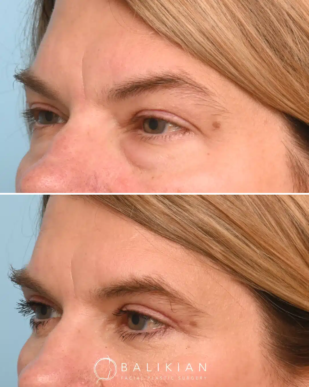 Left oblique view before and after lower eyelid surgery demonstrating natural correction of under-eye bags and improved skin texture.