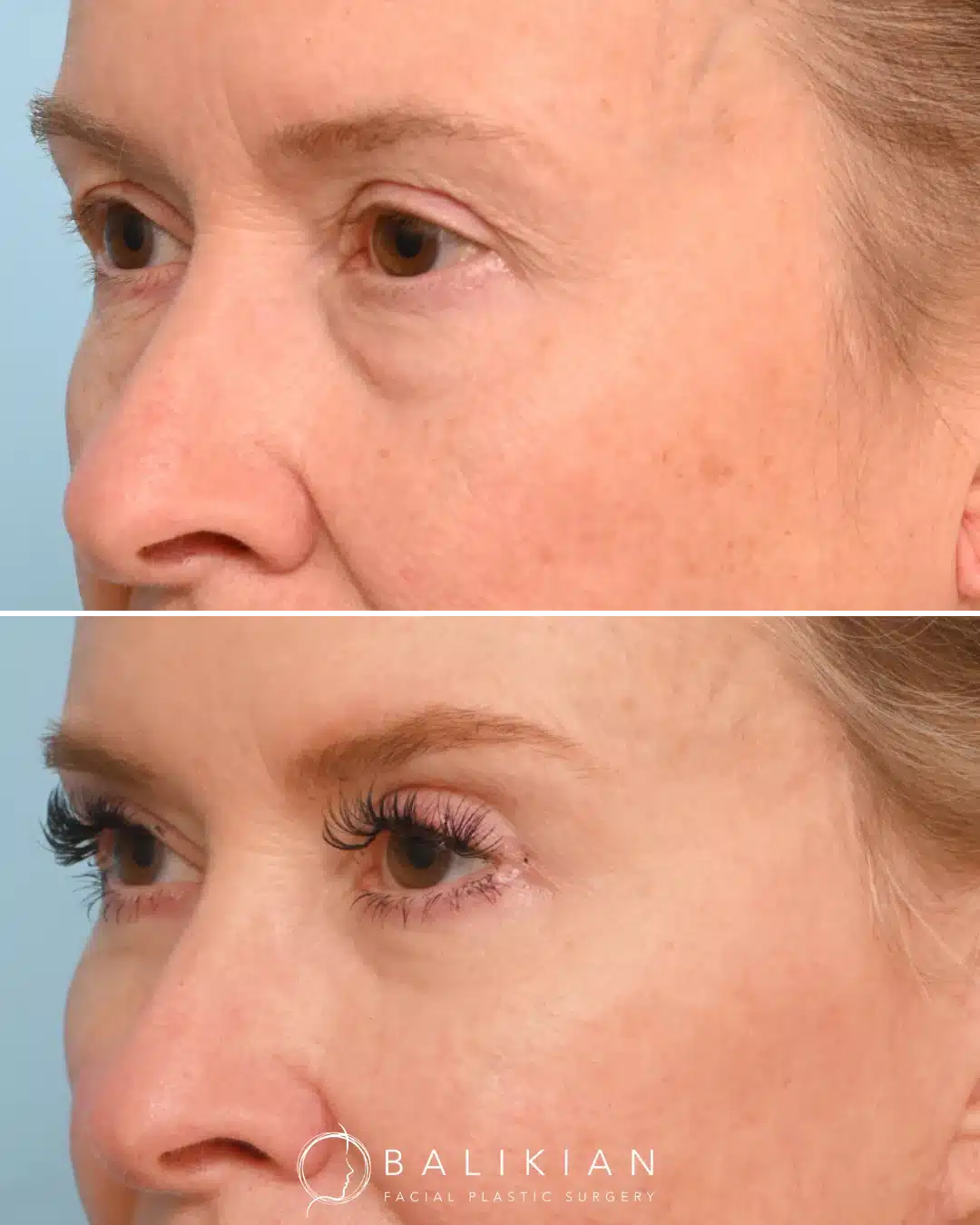 Left oblique view showing upper and lower eyelid improvement after blepharoplasty with smoother, natural eyelid transitions.