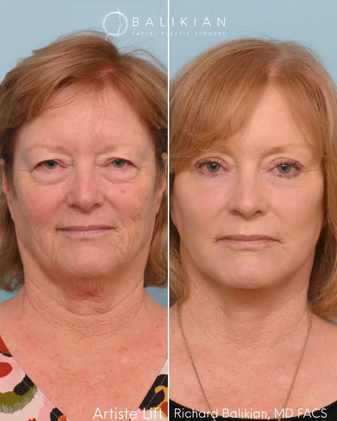 Front view before and after a deep plane facelift performed by Dr. Richard Balikian.