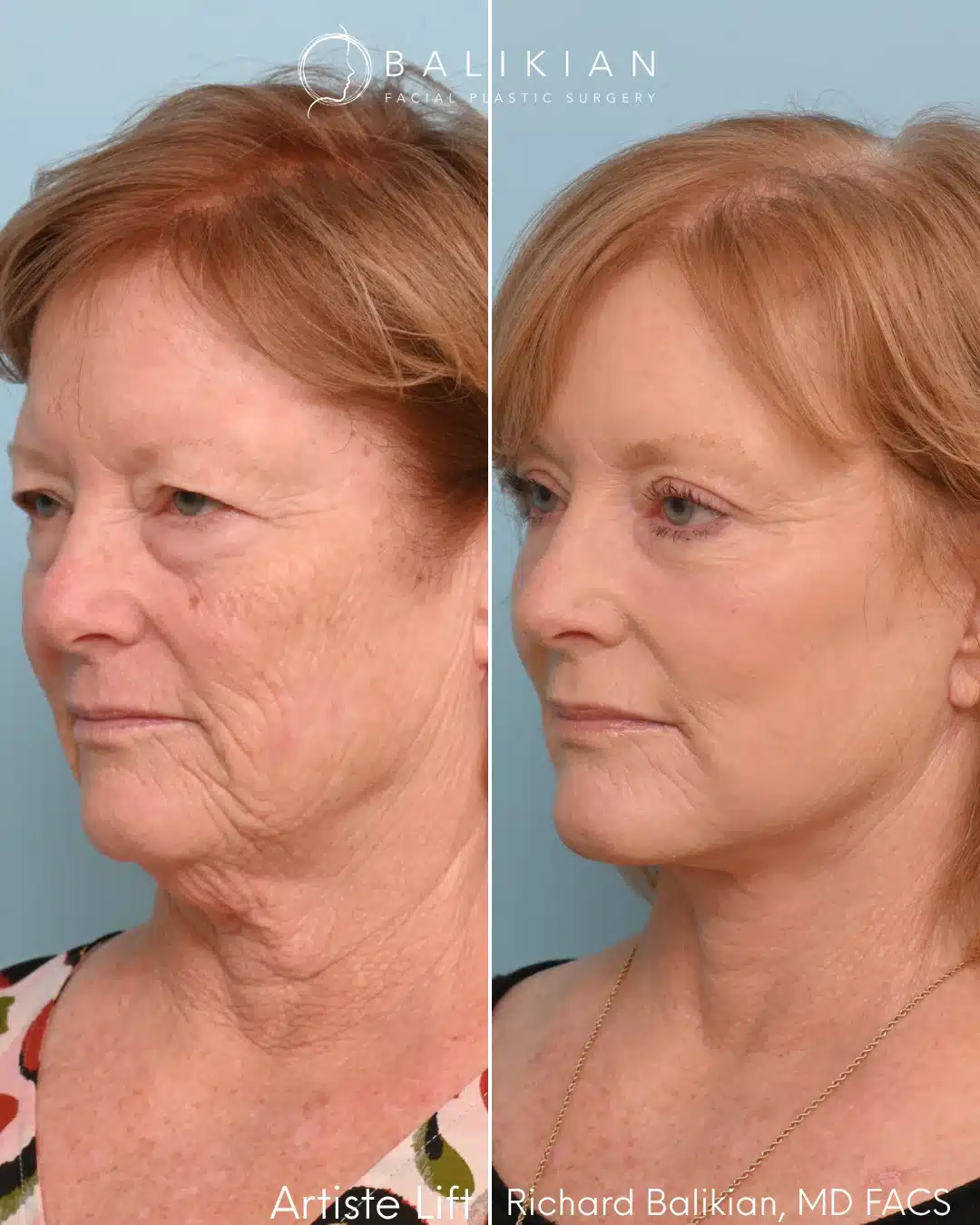 Before and after left oblique view of a deep plane facelift by Dr. Richard Balikian demonstrating lifted midface structure, smoother jawline, and balanced rejuvenation.