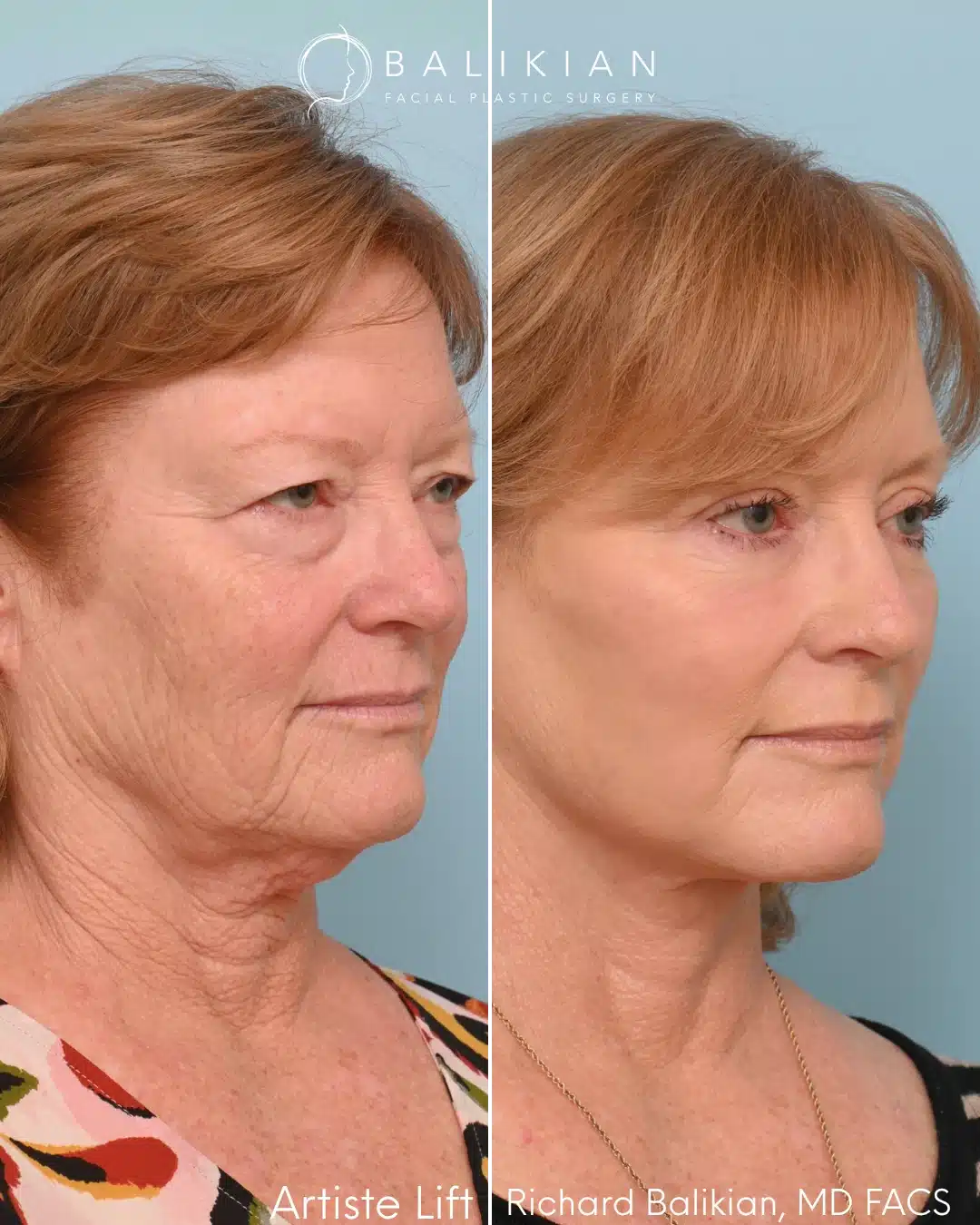 Before and after right oblique view of a deep plane facelift performed by Dr. Richard Balikian.