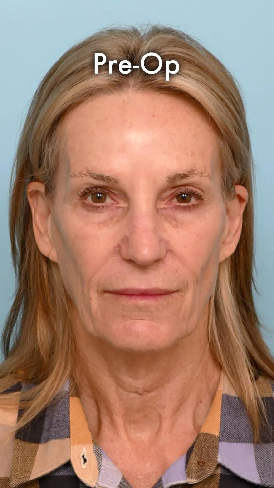 Frontal view of a woman before a preservation deep plane facelift showing natural aging changes in the face and neck.