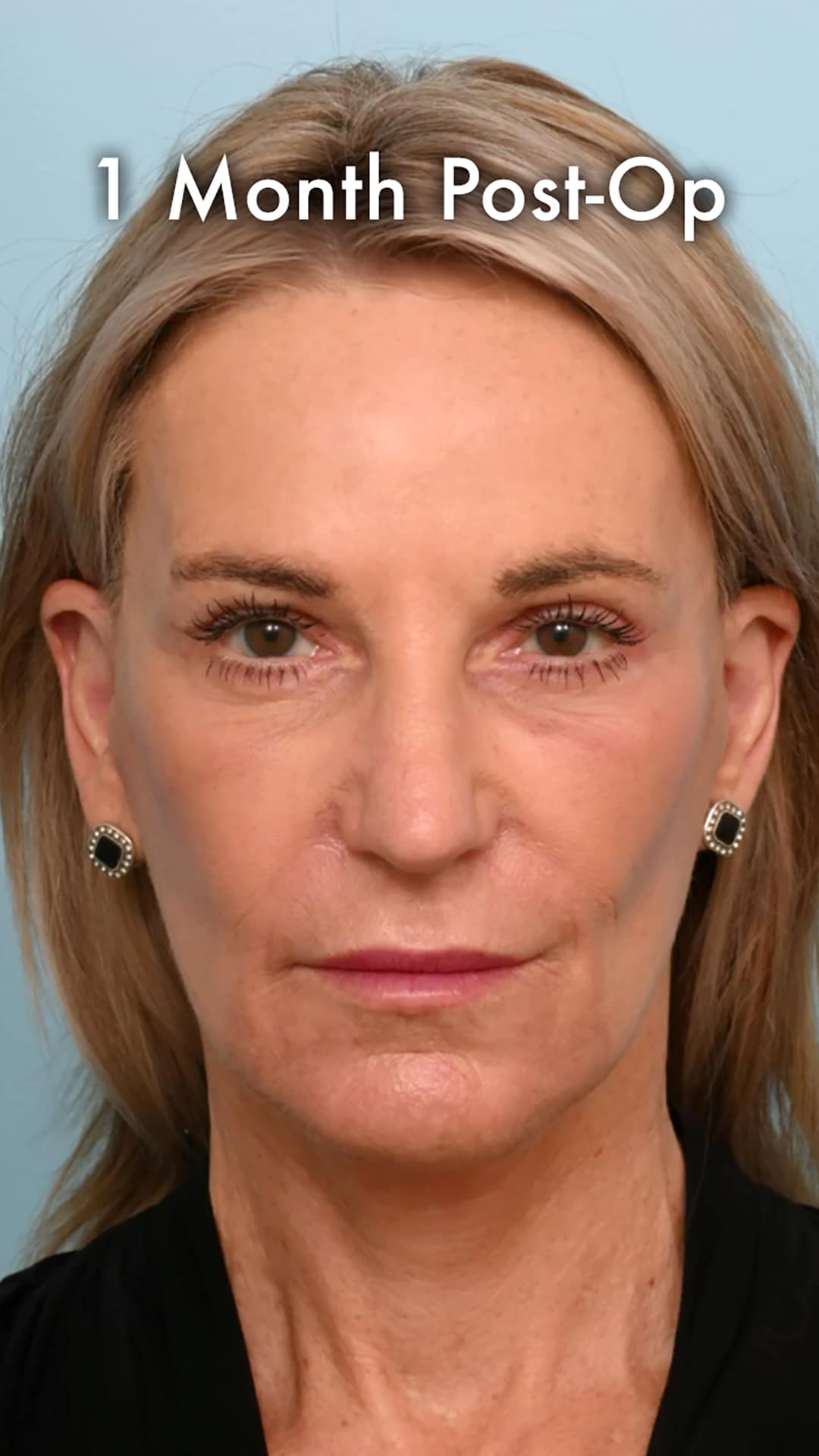 One month after a preservation deep plane facelift showing defined jawline, mild residual swelling, and healed incisions.