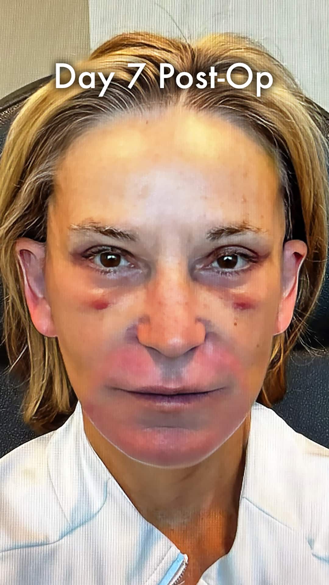 One week after a preservation deep plane facelift with sutures in place, mild bruising, and softening facial swelling.