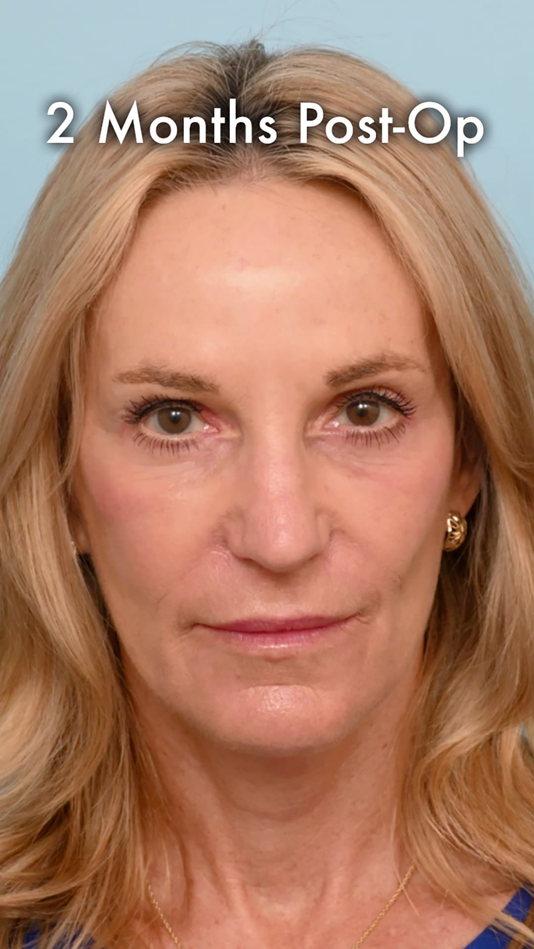 Two months after a preservation deep plane facelift with natural facial definition and minimal remaining swelling.