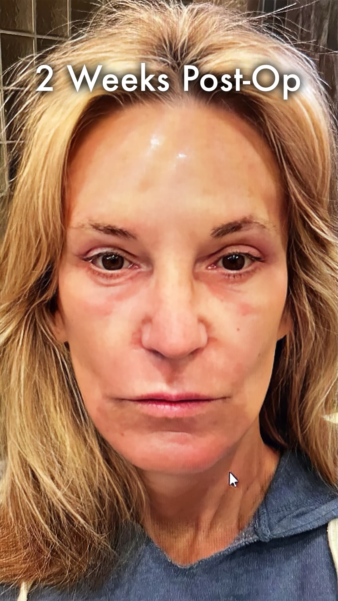 Two weeks after a preservation deep plane facelift with makeup-ready skin, fading redness, and improved facial contour.