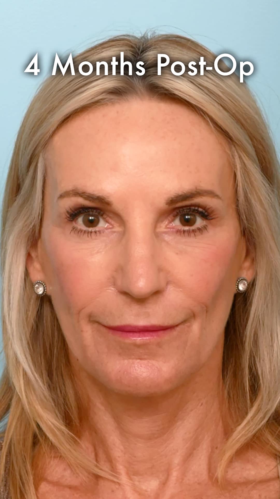 Four months after a preservation deep plane facelift showing refined, natural results with smooth skin and full healing.