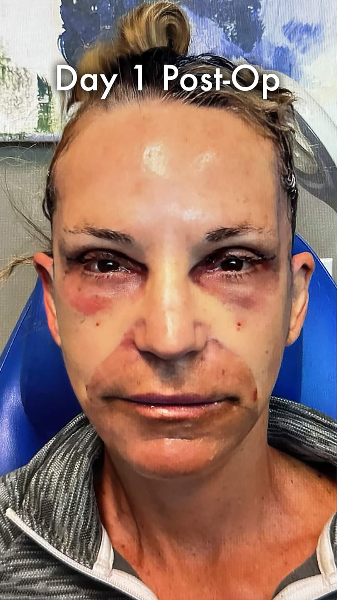Day 1 after a preservation deep plane facelift with controlled swelling, bruising under the eyes, and protective dressing.