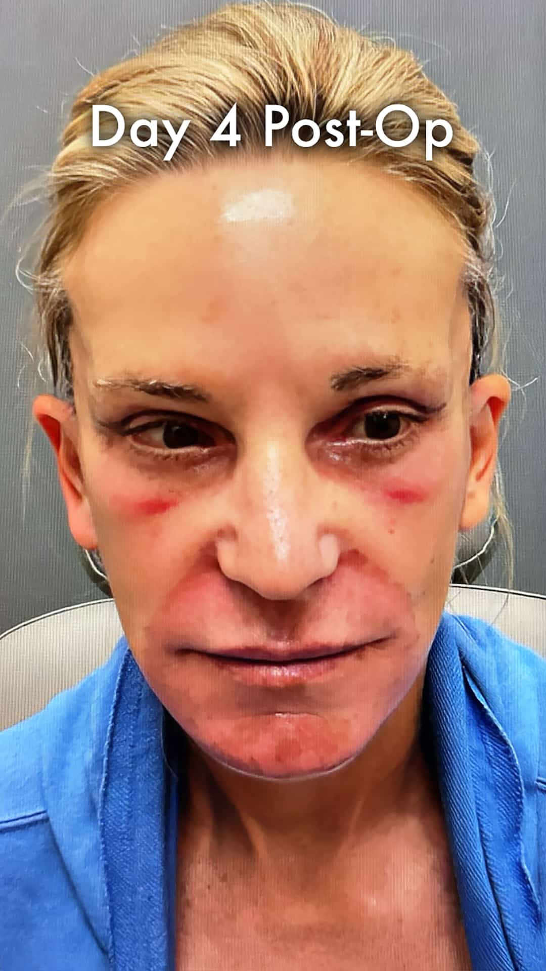 Day 4 after a preservation deep plane facelift showing early reduction in swelling and initial skin healing.