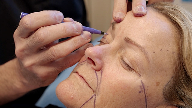 Close-up of Dr. Richard Balikian marking a patient’s upper eyelids while she is seated and relaxed before upper blepharoplasty surgery, showing careful planning for precise, natural-looking results.