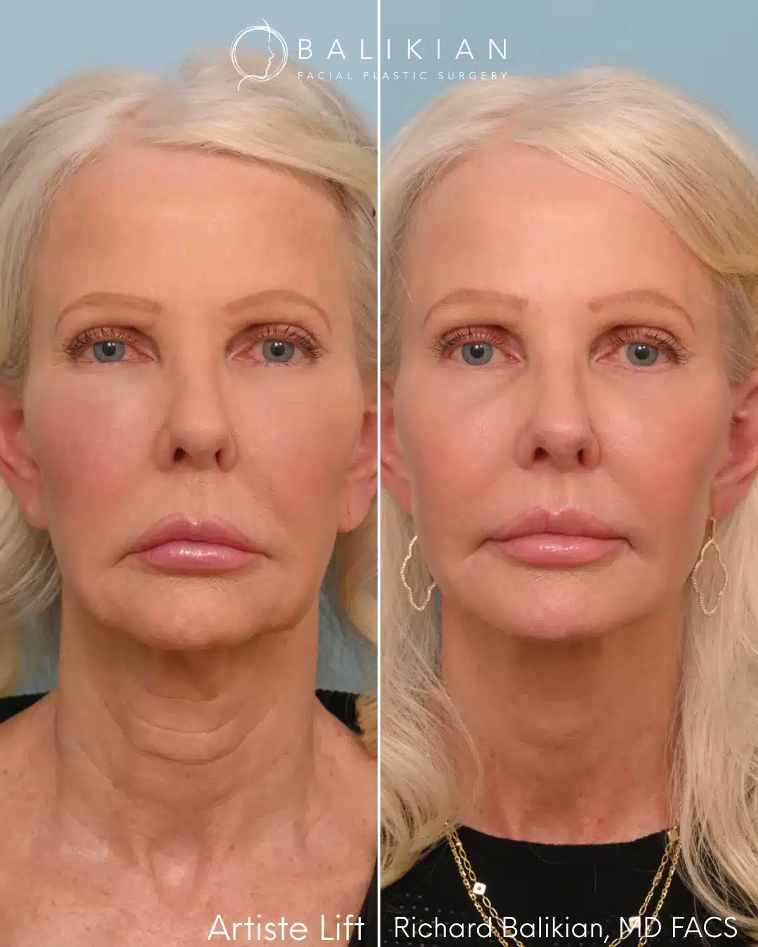 Front view before and after facelift surgery by Dr. Richard Balikian showing smoother skin texture, lifted cheeks, and a youthful, harmonious facial appearance.