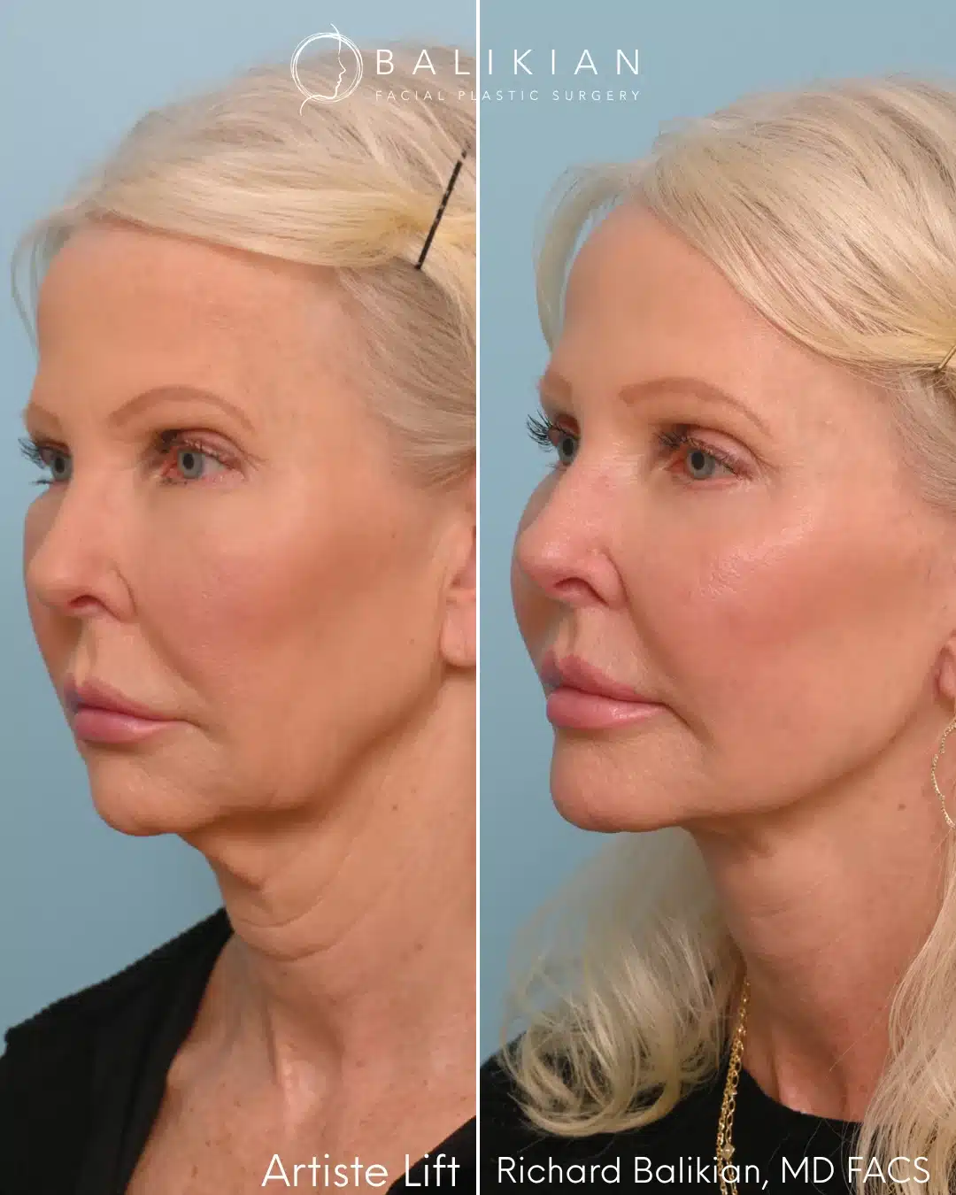 Before and after left oblique view of a facelift performed by Dr. Richard Balikian.