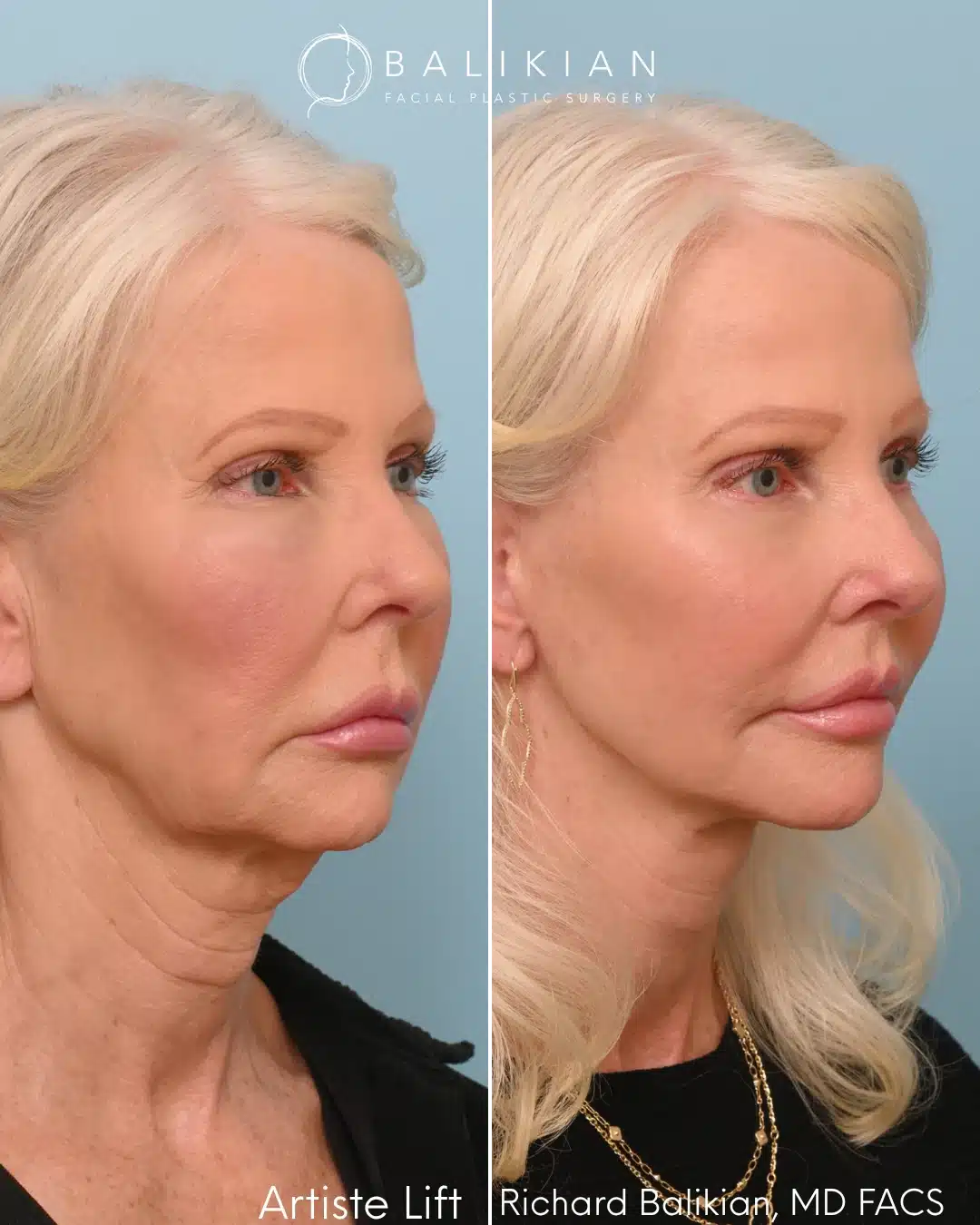 Before and after right oblique view of a facelift by Dr. Richard Balikian, highlighting improved jawline contour, neck tightening, and natural restoration of facial balance.