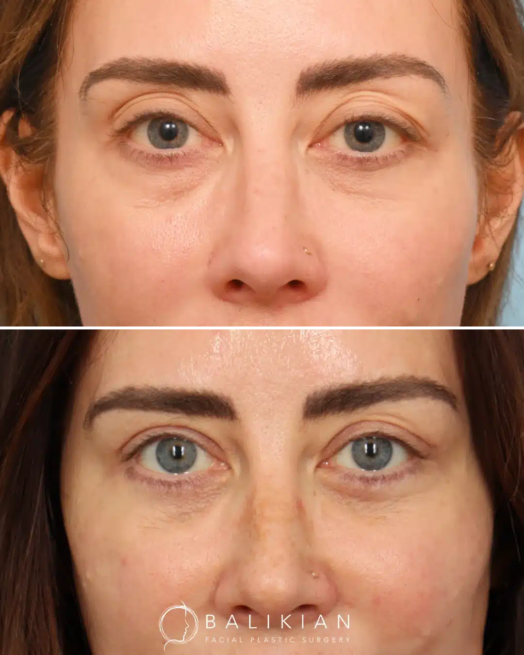 Front view before and after upper and lower eyelid lift showing reduced wrinkles and improved lower-lid firmness.