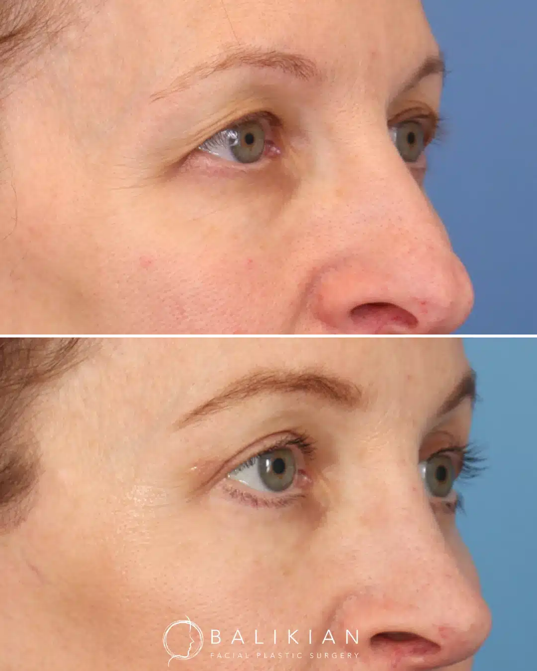 Right oblique view of a woman before and after upper and lower blepharoplasty showing smoother eyelids and a refreshed, natural appearance.