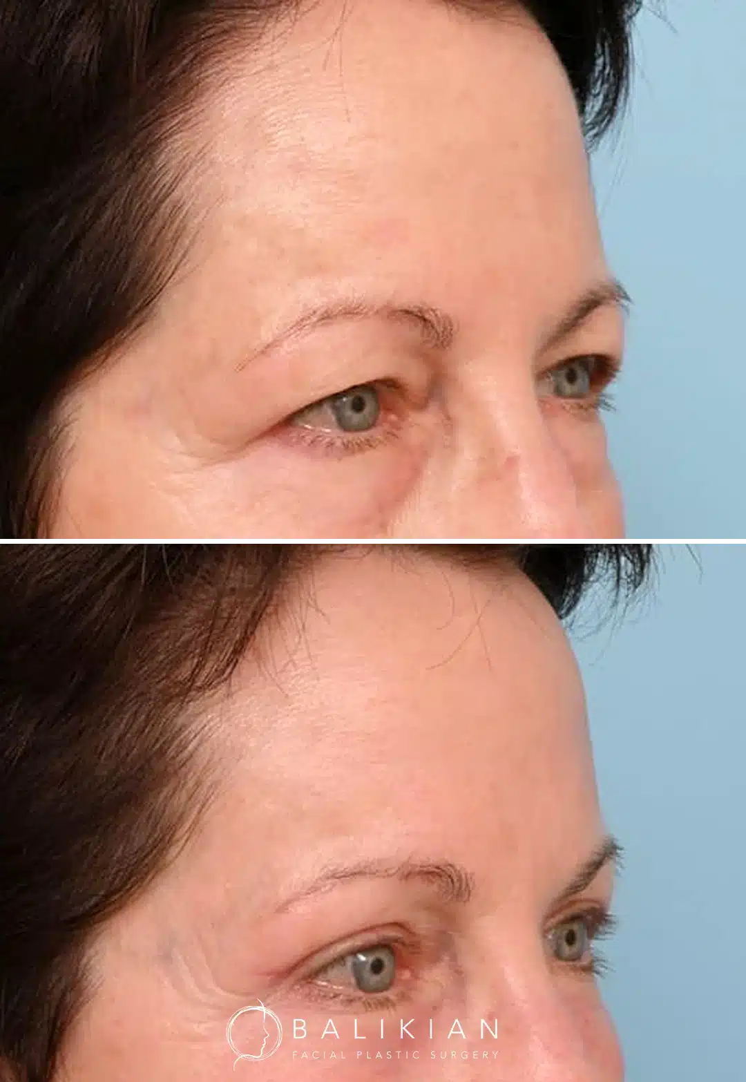 Before and after brow lift showing improved upper eyelid openness and smoother forehead contour in a female patient.
