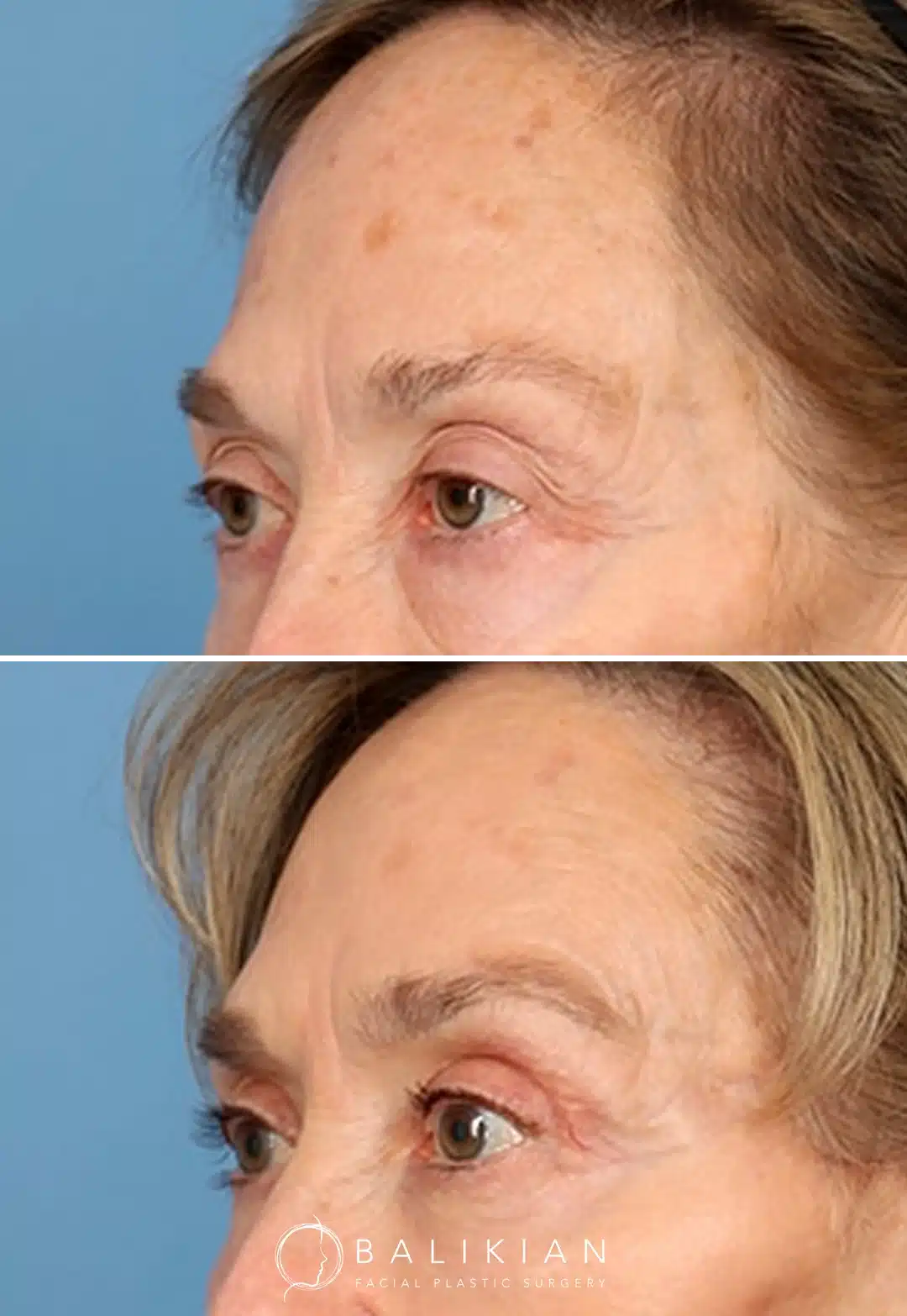 Angled before and after photos of a woman in her seventies showing elevated brows and brighter upper eyelids after brow lift surgery.