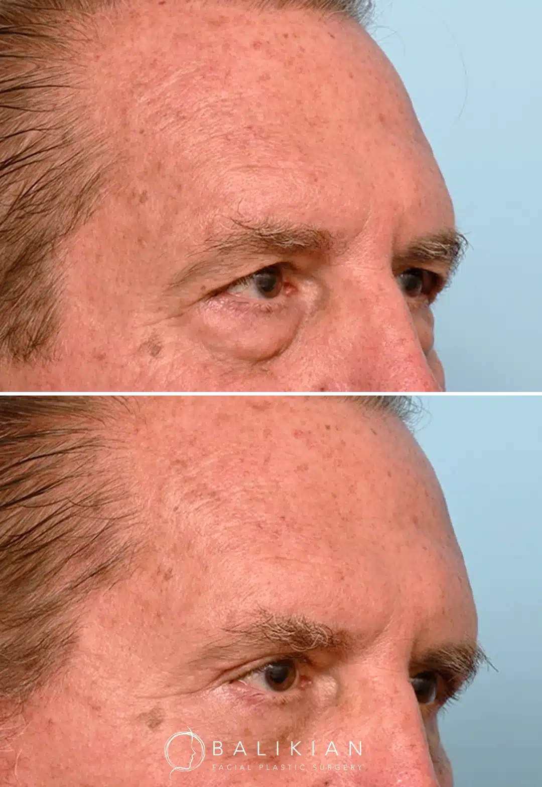 Side view before and after male brow lift and lower blepharoplasty showing smoother lower lids and a lifted brow tail.
