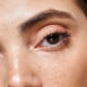 Close up of the lower eyelid and under eye area showing puffiness and shadowing commonly treated with lower blepharoplasty and fat preservation techniques.