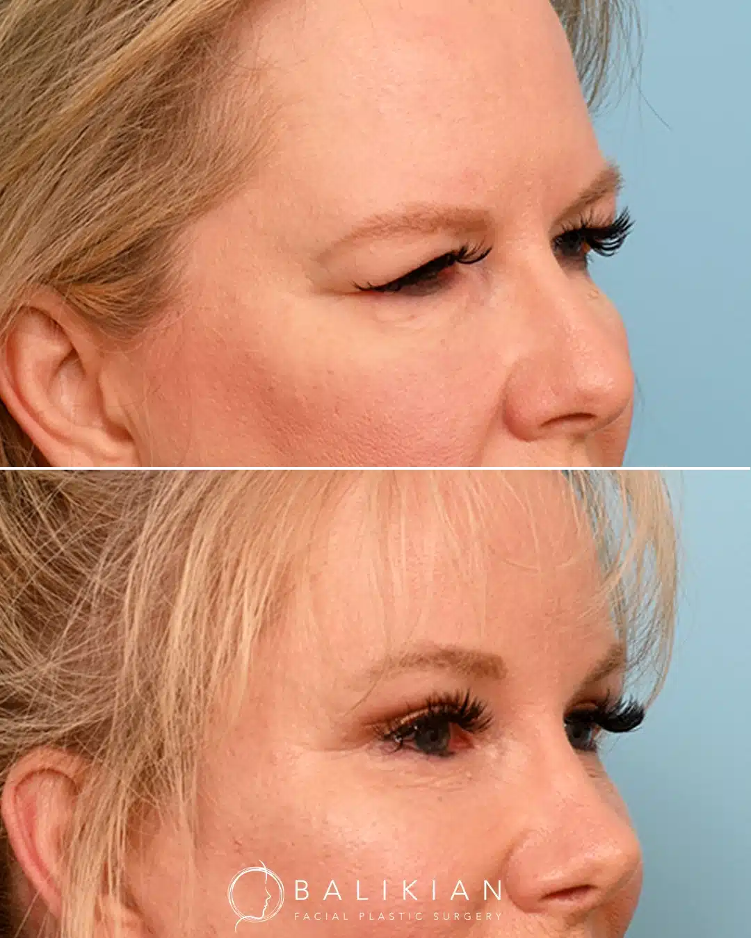 Angle before and after results of eye rejuvenation surgery demonstrating lifted upper eyelids, reduced lower eyelid creasing, and a more youthful periorbital contour.