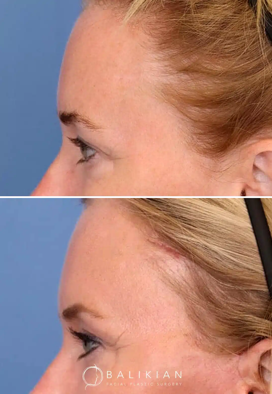 Side view before and after temporal brow lift showing smoother forehead contour and elevated brow position.