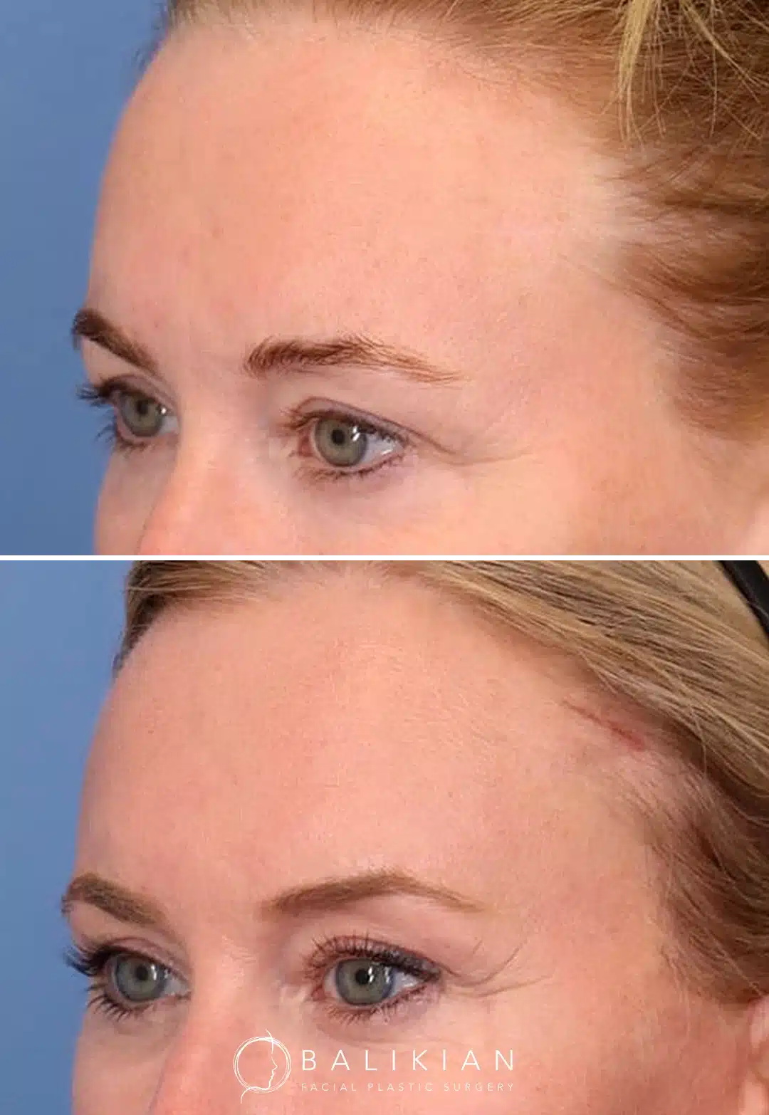 Three quarter view before and after brow lift demonstrating lifted outer brow, smoother crow’s feet area and refreshed eye shape.