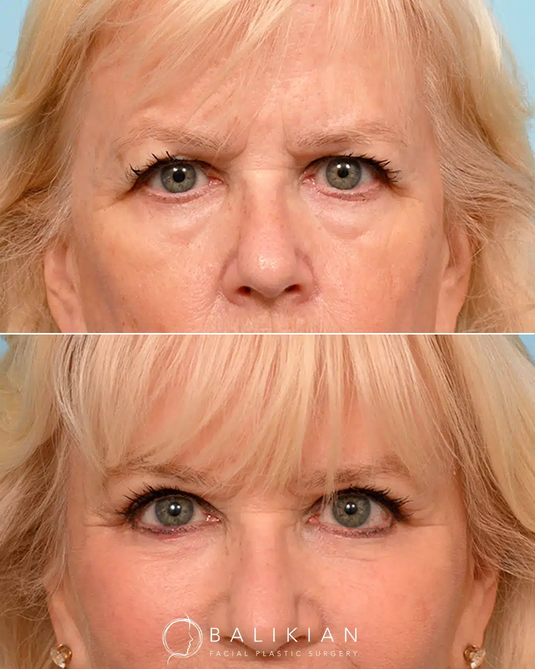 Frontal before and after upper and lower blepharoplasty showing improved upper eyelid heaviness and reduced under-eye bags for a smoother, more refreshed appearance.