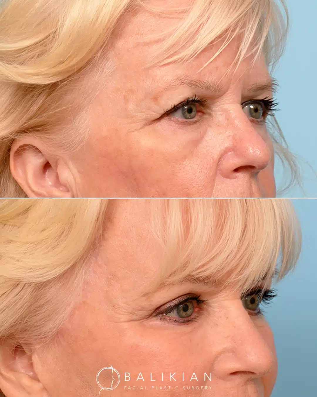 Angled before and after of upper and lower blepharoplasty demonstrating reduced eyelid hooding, softened crow’s feet, and smoother lower eyelid contours.