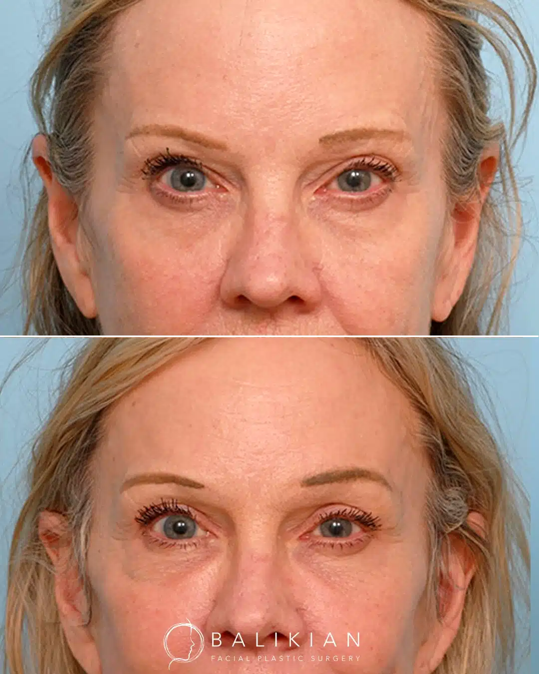 Frontal before and after upper and lower eyelid surgery showing lifted upper eyelids, reduced under-eye hollowness, and a brighter overall eye appearance.