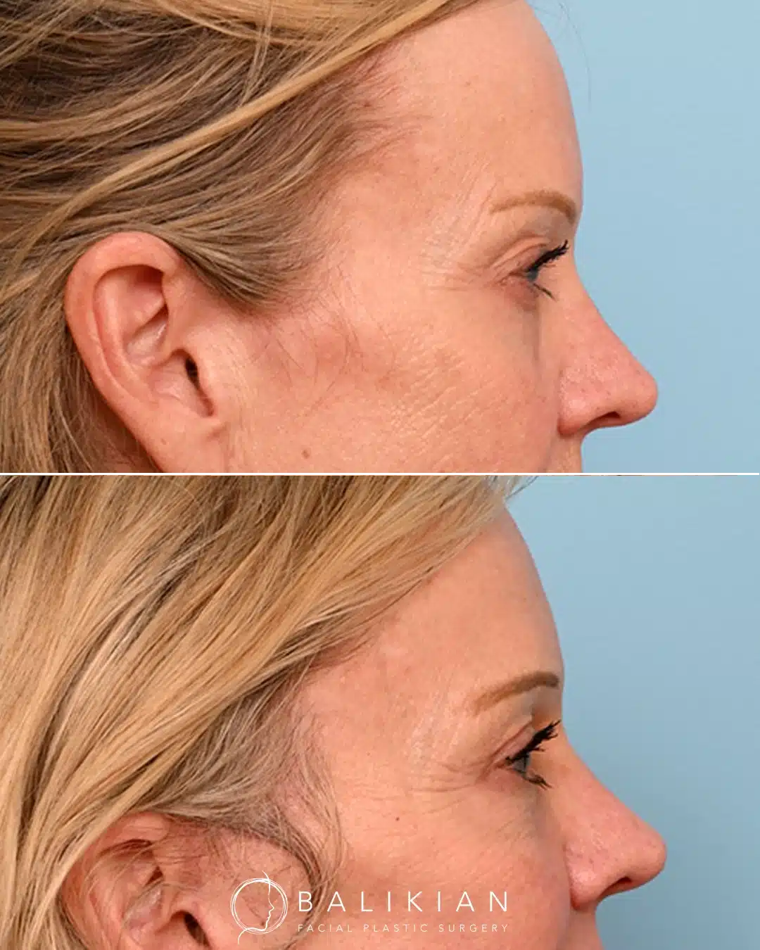 Side-view before and after upper and lower eyelid surgery showing tighter upper eyelid skin, smoother under-eye region, and enhanced definition of the eye contour.